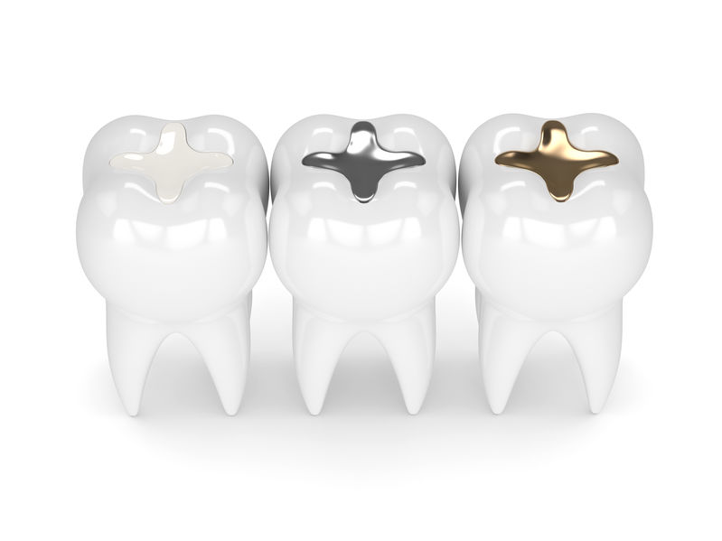 3d render of teeth with gold, amalgam and composite inlay dental filling over white background